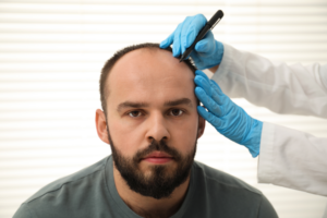 Hair Transplant
