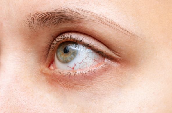 Uveitis 2