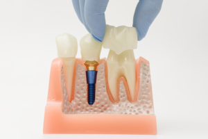 dental veneers and crowns