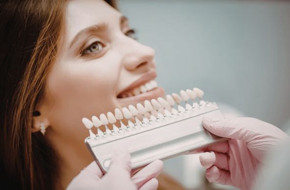 dental veneers